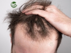 Bị rụng tóc nhiều ở nam: Nguyên nhân rụng tóc nam và 5 cách khắc phục