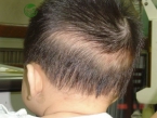 Bị rụng tóc vành khăn ở trẻ: Nguyên nhân và cách chăm sóc tóc hiệu quả