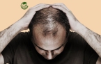 Rụng tóc màng: Nguyên nhân và phương pháp điều trị