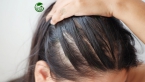 Rụng tóc nhiều bất thường ở nữ: Cảnh báo dấu hiệu bệnh lý nghiêm trọng