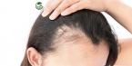 Rụng tóc nhiều là do đâu: Các nguyên nhân phổ biến và cách phòng ngừa