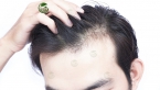 Rụng tóc nhiều ở nam tuổi dậy thì: Nguyên nhân và cách điều trị
