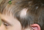 Rụng tóc trẻ em: Các nguyên nhân và biện pháp xử lý hiệu quả
