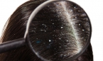 Tóc bị rụng có hạt trắng: Nguyên nhân và cách khắc phục