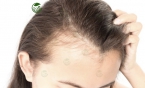 Tóc bị rụng nhiều do đâu? Nguyên nhân và cách phòng ngừa hiệu quả