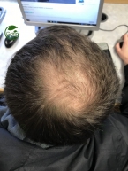 Tóc bị rụng ở đỉnh đầu: Nguyên nhân và cách cải thiện từ liệu pháp thiên nhiên